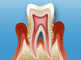 歯周病治療イメージ画像